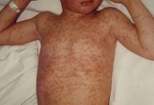 هشدار شیوع سرخک در کهگیلویه و بویراحمد / لزوم واکسیناسیون کودکان