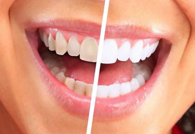 رنگ دندان ها چه چیزی درباره سلامت شما می‌گوید؟ / خطرناک ترین لکه چه رنگی است؟